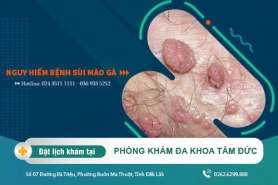 Cách điều trị sùi mào gà tại Đắk Lắk - Bệnh giống với sùi mào gà là gì?