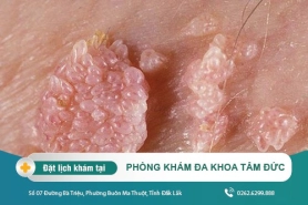 Cách chữa sùi mào gà tại Đắk Lắk - Sùi mào gà có tự khỏi không?