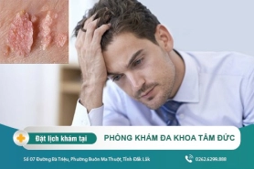 Cách chữa sùi mào gà tại Đắk Lắk – Dấu hiệu sùi mào gà ở nam giới là gì?