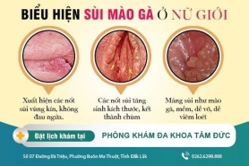 Cách chữa sùi mào gà tại Đắk Lắk – Dấu hiệu sùi mào gà ở nữ giới là gì?