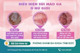 Những Cách Nhận Biết Và Hậu Quả Của Sùi Mào Gà Ở Nữ Giới